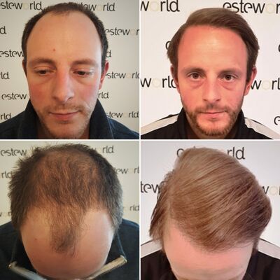 Bram, ik word kaal, hier wilde ik wat aan laten doen!