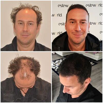 Hans de Vries, Lage kosten haartransplantatie voor goede kwaliteit!