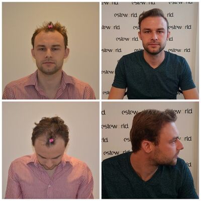 Manuel blij met zijn haartransplantatie resultaat!