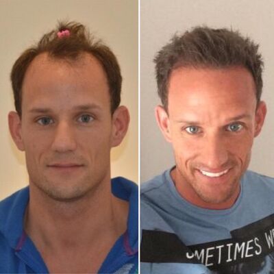 Eindresultaat van de haartransplantatie Dhr. Bos