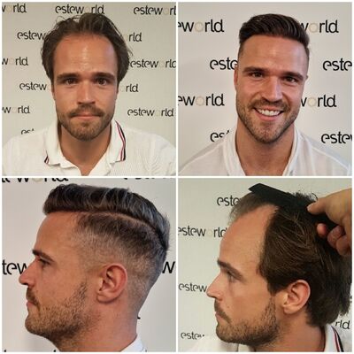 Als je haar langzaam verdwijnt? Haartransplantatie bij Esteworld!