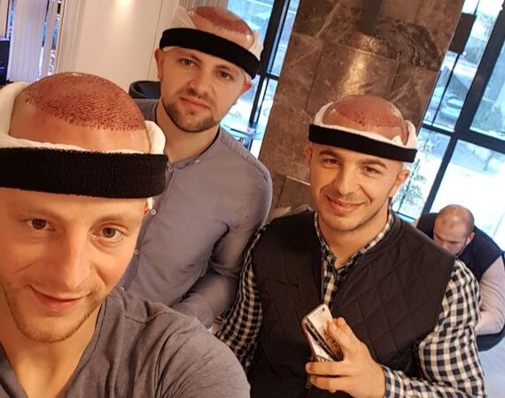 Hoe ziet een haartransplantatie Turkije consult eruit?