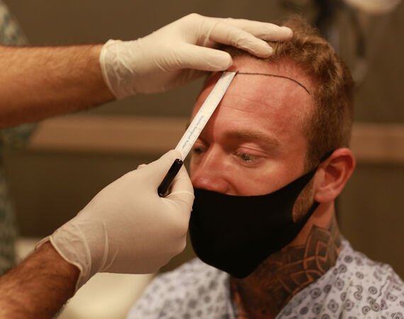 Hoe ziet een haartransplantatie Turkije consult eruit?