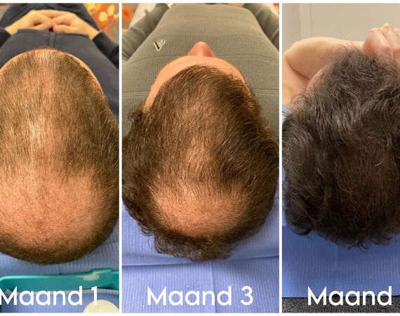 XL Hair Mesotherapie