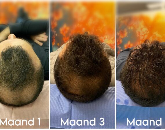 XL Hair Mesotherapie