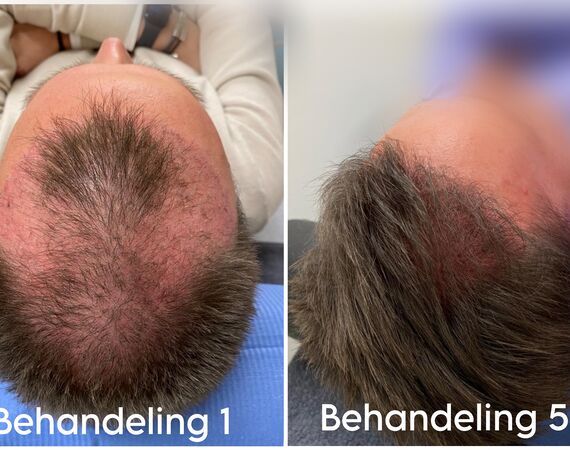 XL Hair Mesotherapie