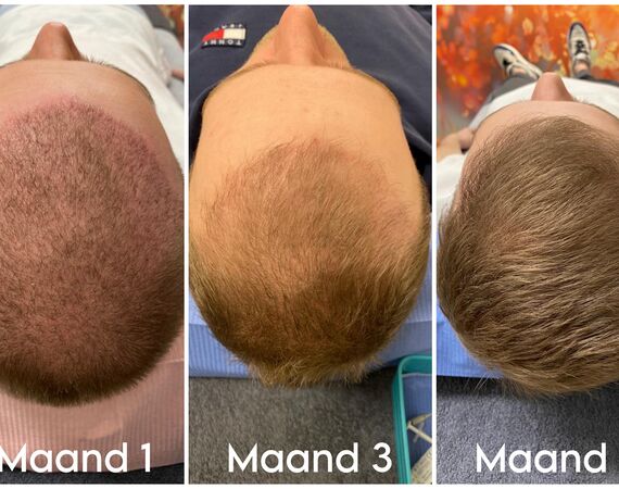 XL Hair Mesotherapie