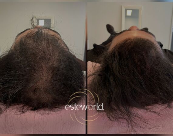 XL Hair Mesotherapie
