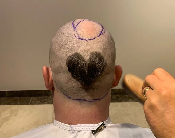 Vanuit België een haartransplantaie in Turkije