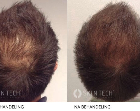 XL Hair behandeling