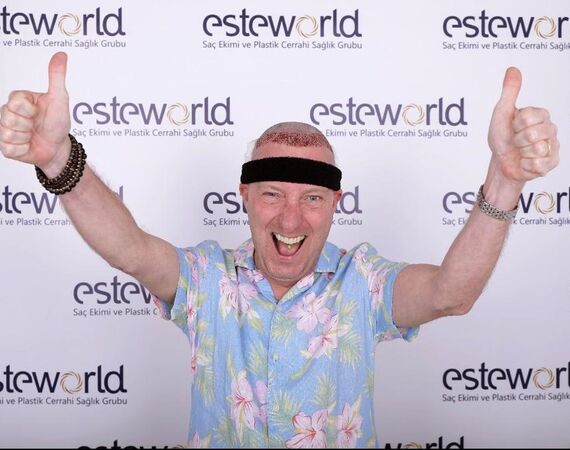 Consult bij Esteworld Haartransplantatie