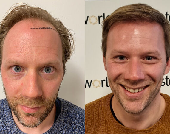 FUE saffier haartransplantatie ervaringen