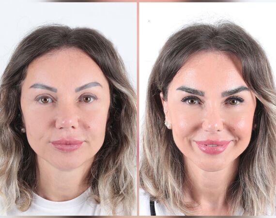 Wenkbrauwtransplantatie ervaringen