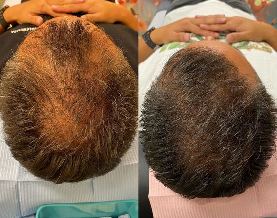 Xl hair in combinatie met een haartransplantatie?
