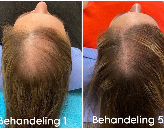 Mesotherapie voor het haar bij Esteworld: een veilige en effectieve behandeling