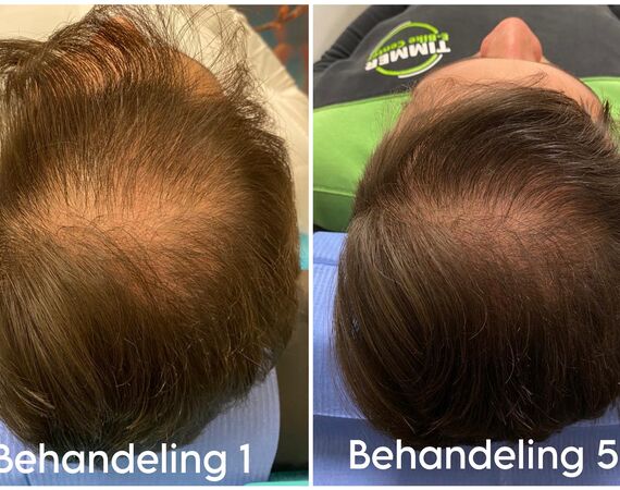 Mesotherapie voor het haar bij Esteworld: een veilige en effectieve behandeling