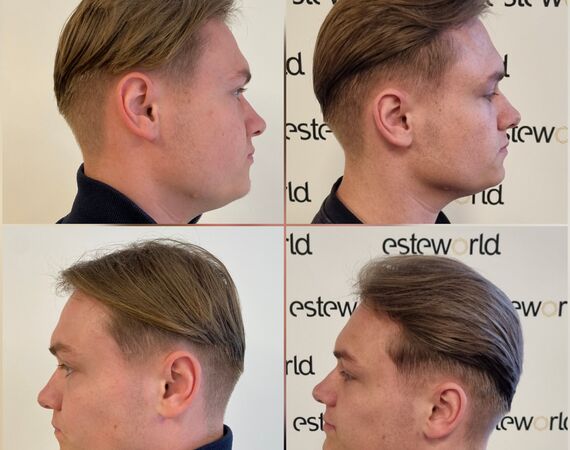 Low Level Laser Therapie (LLLT)