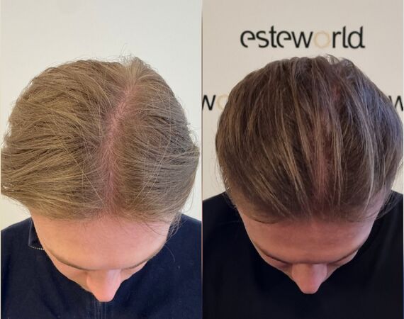 Low Level Laser Therapie (LLLT)