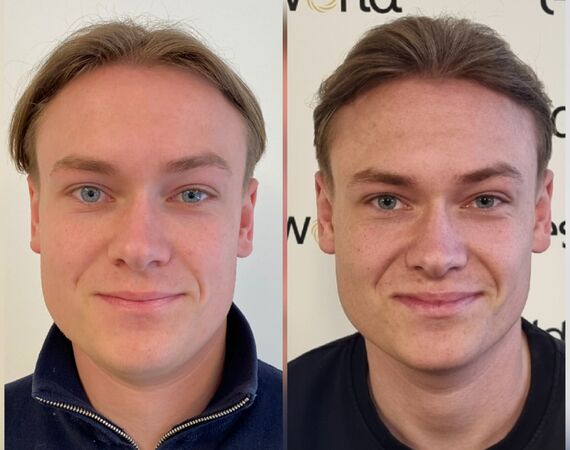 Low Level Laser Therapie (LLLT)