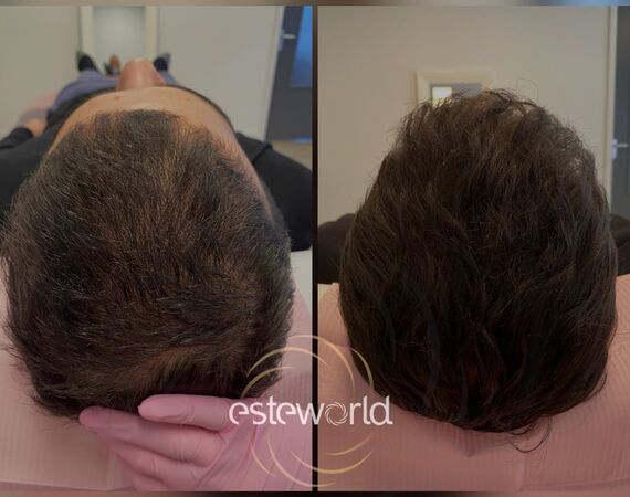 Low Level Laser Therapie (LLLT)