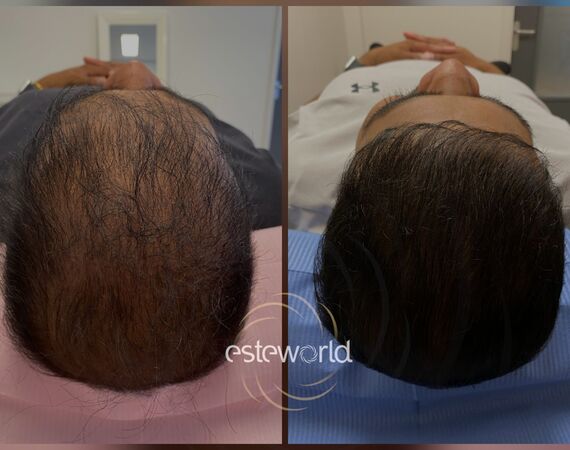 Low Level Laser Therapie (LLLT)