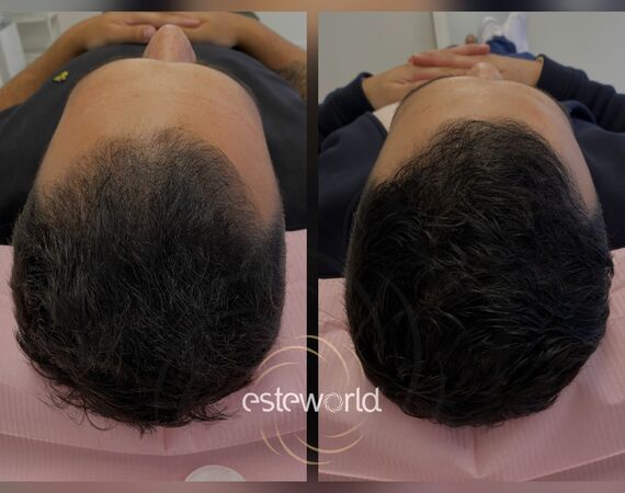 Low Level Laser Therapie (LLLT)