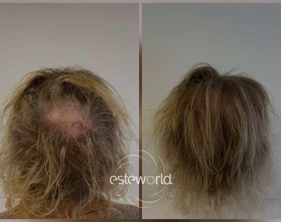 Low Level Laser Therapie (LLLT)