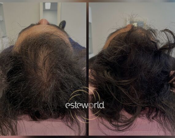 Low Level Laser Therapie (LLLT)