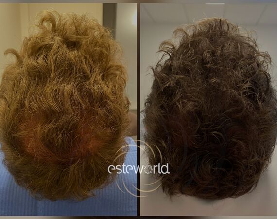 Low Level Laser Therapie (LLLT)