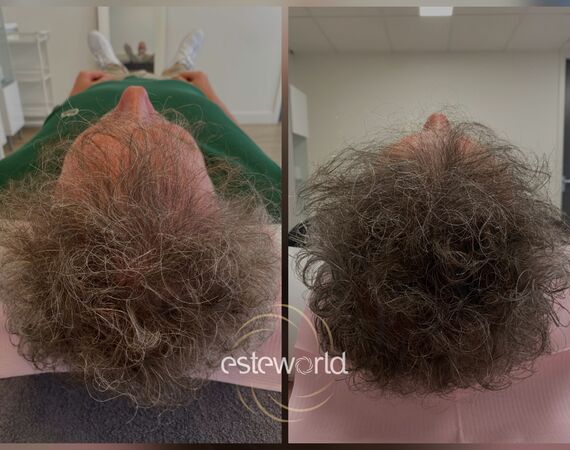 Low Level Laser Therapie (LLLT)