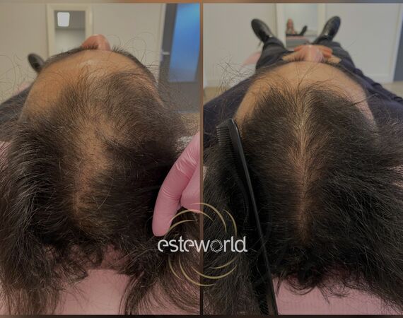 Low Level Laser Therapie (LLLT)