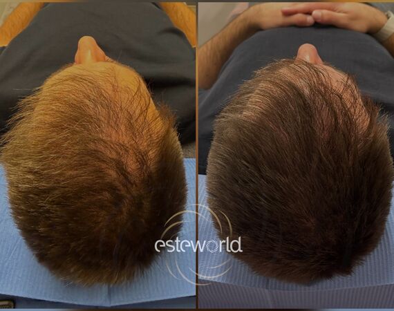 Low Level Laser Therapie (LLLT)