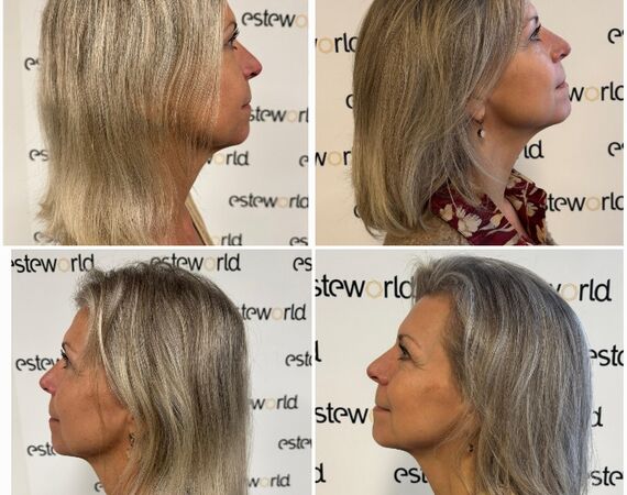 Low Level Laser Therapie Utrecht