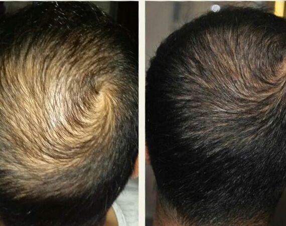 Acell stamcel behandeling