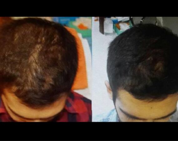 Acell stamcel behandeling