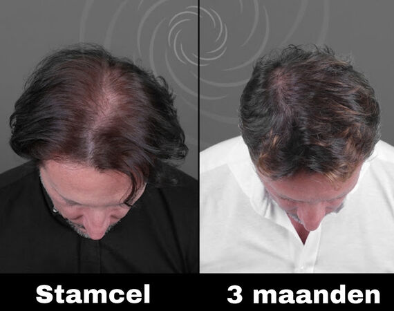 Acell stamcel behandeling