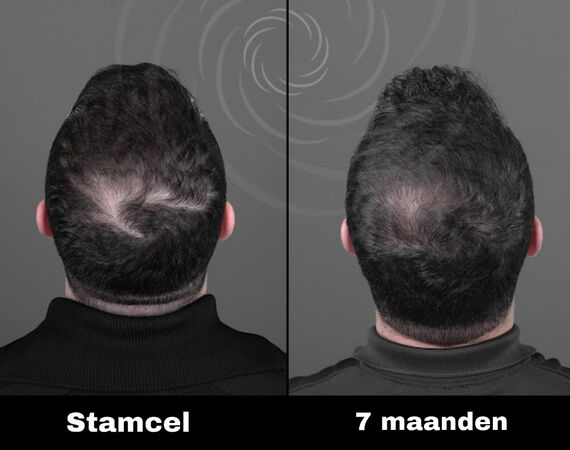 Acell stamcel behandeling