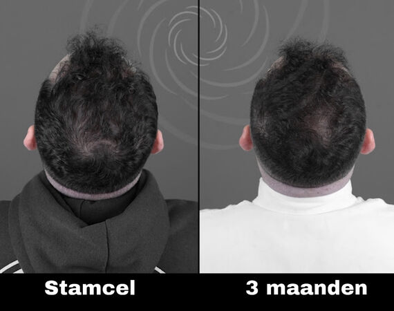 Acell stamcel behandeling