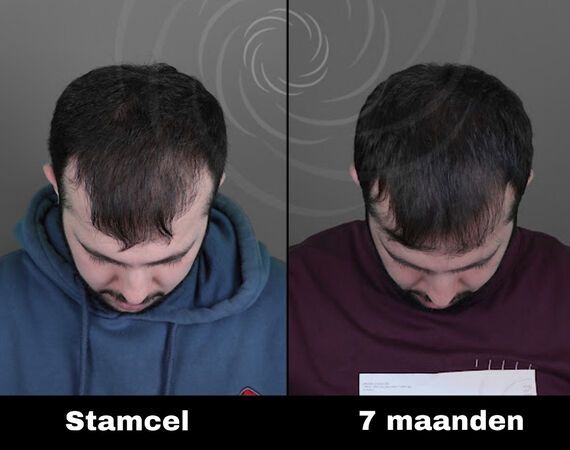 Acell stamcel behandeling