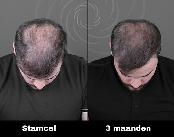 Acell stamcel behandeling