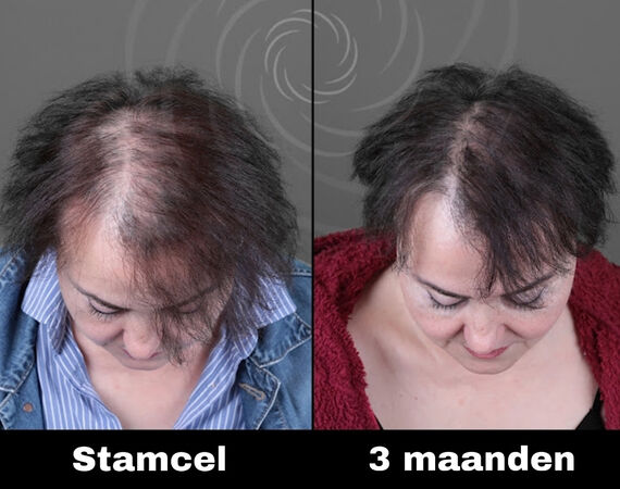 Acell stamcel behandeling