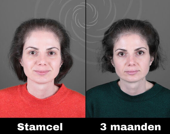 Acell stamcel behandeling