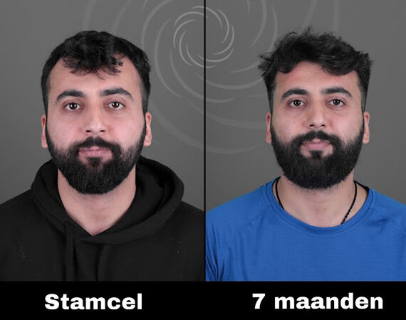 Acell stamcel behandeling