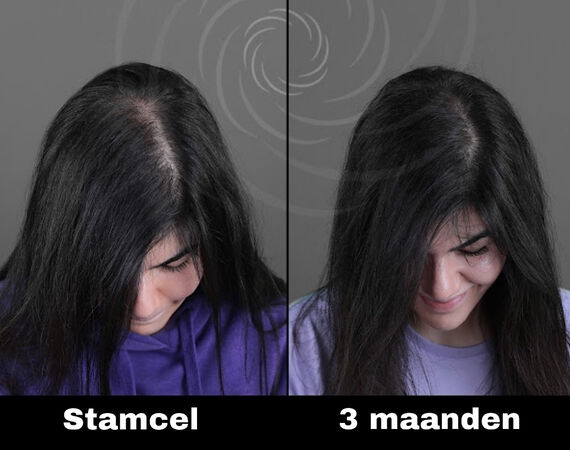 Acell stamcel behandeling