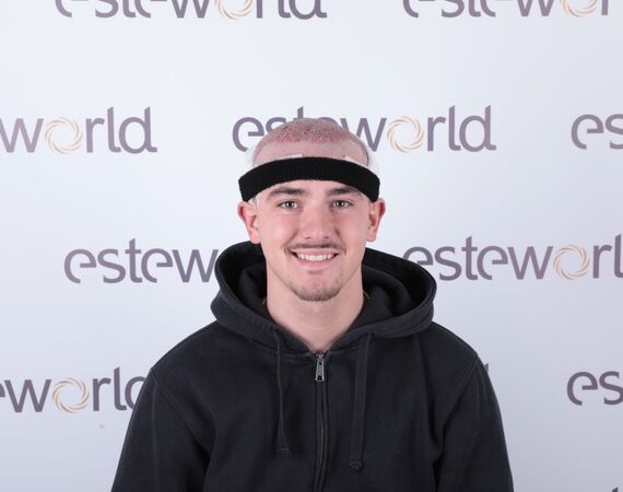 Luca Ferron DHI haartransplantatie bij Esteworld