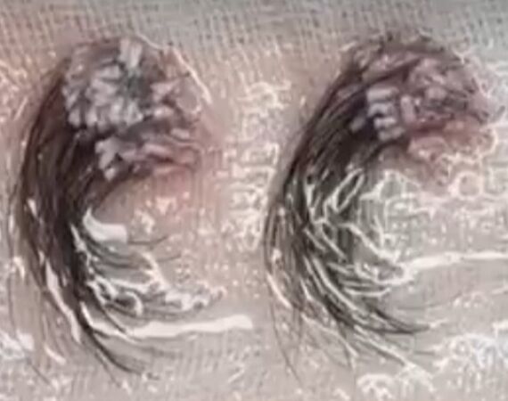 Haartransplantaties zonder scheren en de Long Hair methode