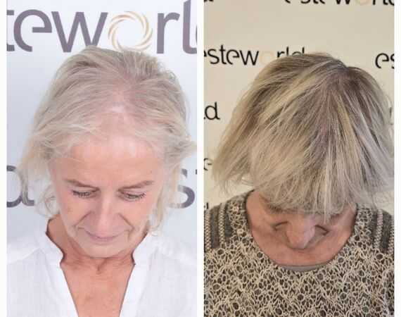 Haartransplantaties zonder scheren en de Long Hair methode