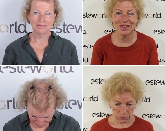Haartransplantaties zonder scheren en de Long Hair methode