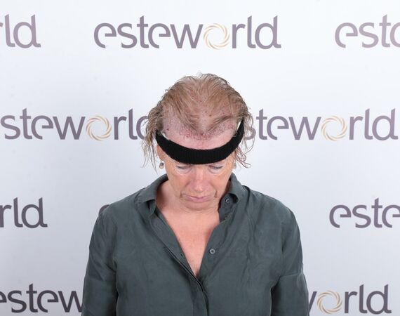 Haartransplantaties zonder scheren en de Long Hair methode