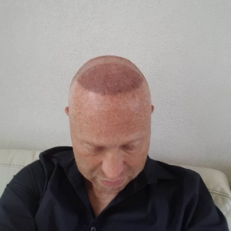 4200 grafts goedkope haartransplantatie Turkije